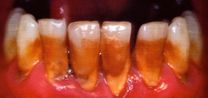 Cigarette Teeth by Sarah Lucas contemporary artwork Print