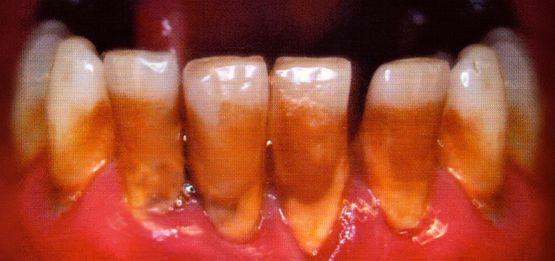 Cigarette Teeth by Sarah Lucas contemporary artwork Print